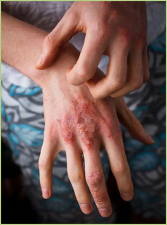 Eczema